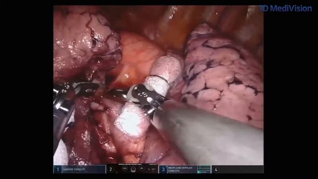 Robotic Pulmonary Resection: Using the Reduced Number of Port смотреть онлайн