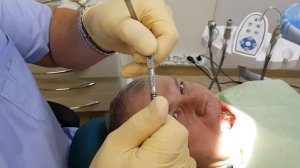 Установка коронок на имплантатах на винтовой фиксации