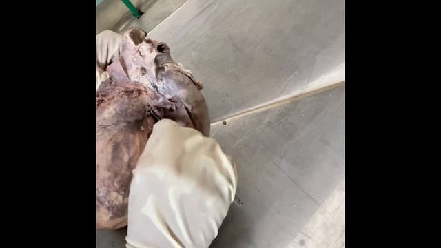 Sinuses of Pericardium Anatomy смотреть онлайн