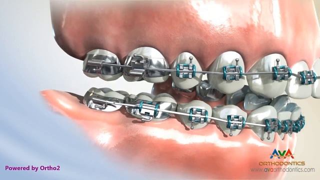 Orthodontics Treatment for Overjet (Overbite) - Headgear vs. Forsus Appliance смотреть онлайн