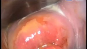 Выполнение биопсии шейки матки