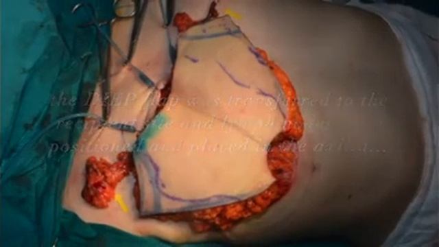 Breast reconstruction & lymphedema treatment with DIEP flap and vascularized lymph node transfer смотреть онлайн