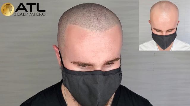 Scalp Micropigmentation/Caucasian/Male смотреть онлайн