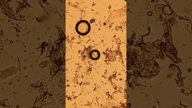 Демодекоз. Подкожный клещ. смотреть онлайн
