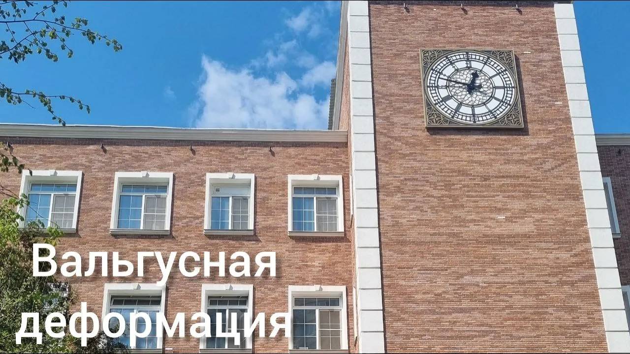 Вальгусная деформация стопы смотреть онлайн