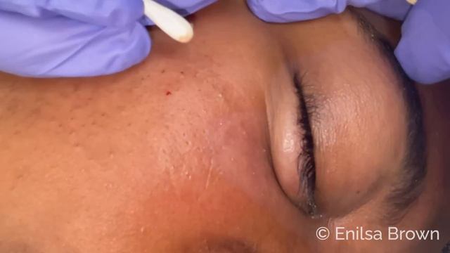 Blackhead Extractions on Netty - Sixth Treatment смотреть онлайн