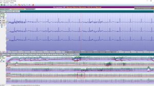 WinIcar. Урок 02 - Удаление зашумлённых участков ЭКГ.