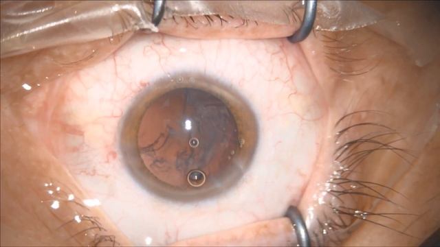 Oculentis Comfort EDOF ,teared rhexis implantation Lukan Mishev Live Stream смотреть онлайн