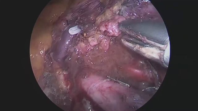 Laparoscopic retroperitoneal lymph node dissection смотреть онлайн