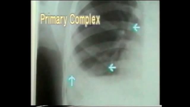 TB PRIMARY COMPLEX | on CHEST X RAY смотреть онлайн