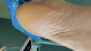 Глубокие трещины / #Кератоз / #Глубокий кератоз / Первый визит / Подология #педикюр