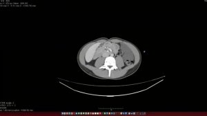 Лучевая анатомия. Брюшная полость. Разбор. К лекции