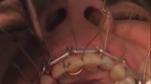 ПЕРЕЛОМ НЧ ДВУХЧЕЛЮСТНОЕ ШИНИРОВАНИЕ