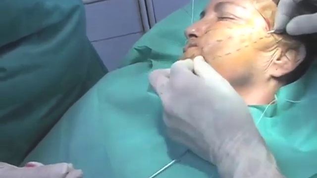 Нитевой лифтинг Spring Thread. Презентационный ролик. смотреть онлайн