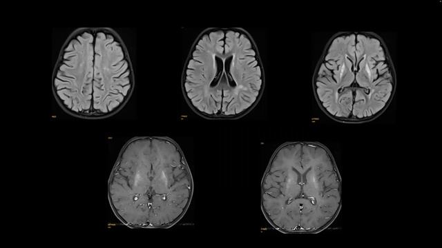 Paediatric Neuroscience Case Discussion Grand Rounds : 31st March, 2023 смотреть онлайн