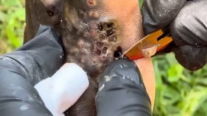 Wellington's left foot jigger dug - OMG, CLUSTER PACKED THERE - watch full video @riseupsociety.net