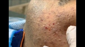 Удаление черных точек 2021 - Remoção de cravo 2021 - Pimple Popping 2021 Blackhead Removal