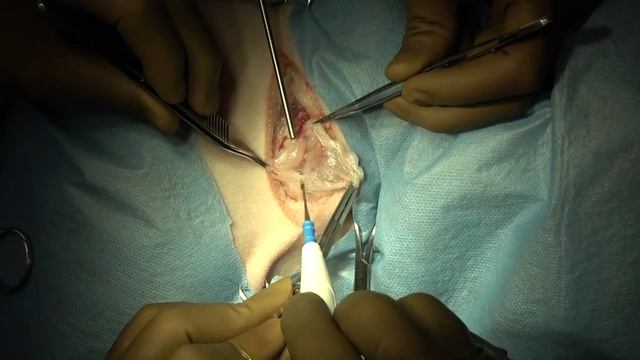 superficial cervical lymph node resection смотреть онлайн