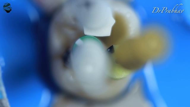 Access Opening in Maxillary Third Molar | Biomechanical Preparation смотреть онлайн