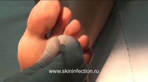 Удаление сухой мозоли видео