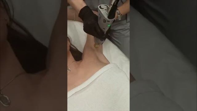 Лазерная эпиляция подмышек смотреть онлайн