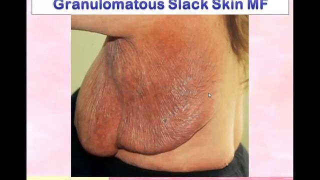 Mycosis Fungoids смотреть онлайн
