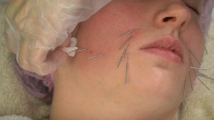 Подтяжка овала. Урок авторского курса Ольги Евдокимовой «Акупунктурный лифтинг лица»