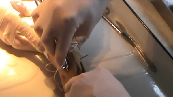 Хирургические прерывистые швы. Docent A.D. Stepanov, ПДАТУ