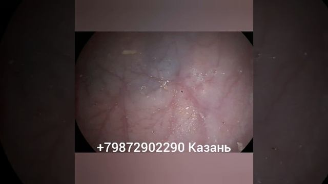 Как удалить иголку из желудка смотреть онлайн