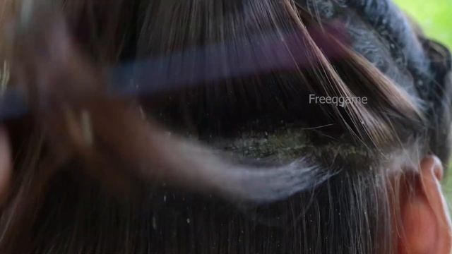 Dandruff removal ! Dandruff shampoo ll Scalp Psoriasis # 932 смотреть онлайн