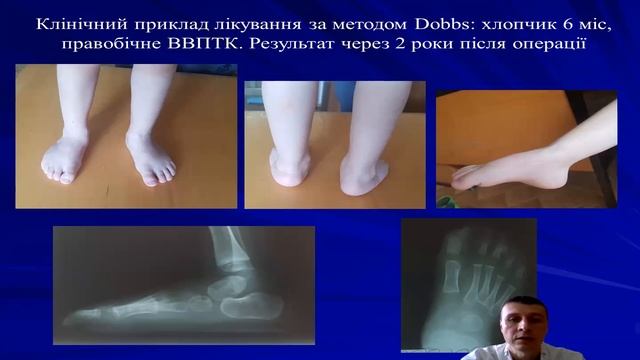 Плоско-вальгусна стопа. Лікування у дітей / Flexible And Rigid Flatfoot. Surgery Treatment