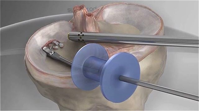 Резекция мениска