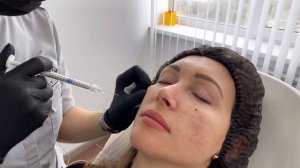 Коррекция носощечной борозды препаратом Radiesse