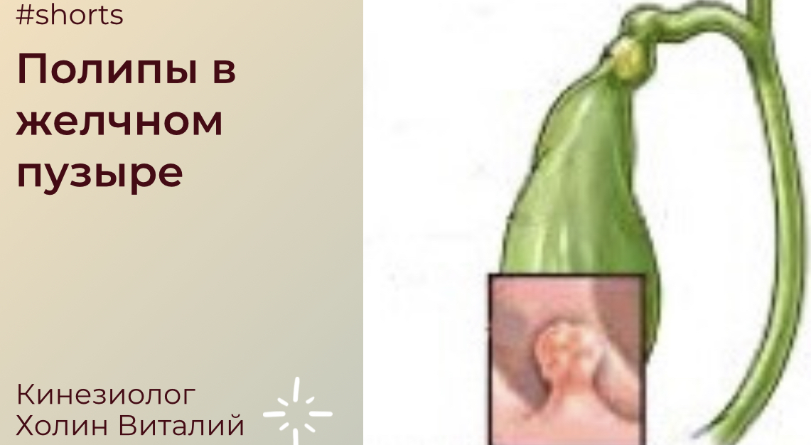 Полипы в желчном пузыре смотреть онлайн