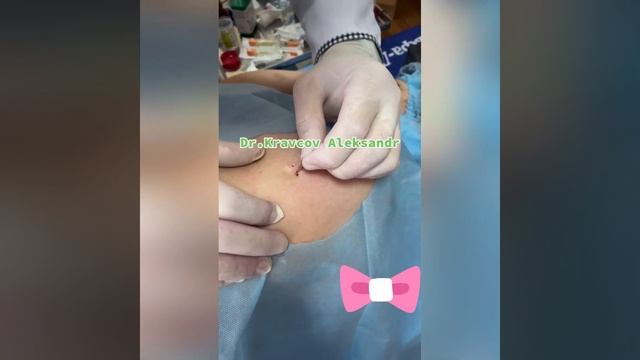Удаление фибромы смотреть онлайн