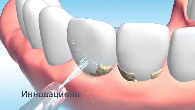 Какой ирригатор выбрать? смотреть онлайн