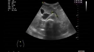 Ультразвуковая анатомия: Печень. Поджелудочная железа. Селезенка