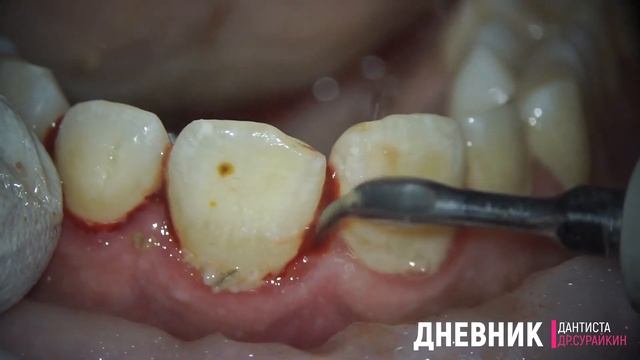 чистка зубов ультразвуком и удаление зубного камня смотреть онлайн