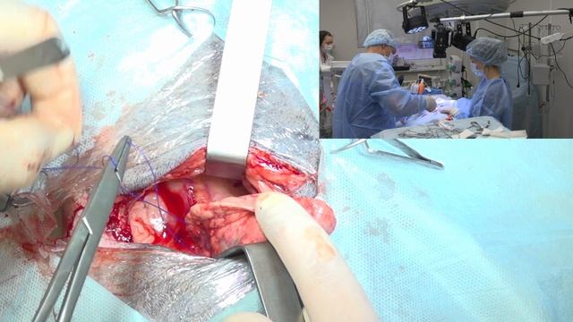 Удаление новообразования легкого. смотреть онлайн