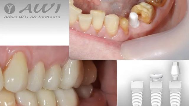 Клинический случай 8 с применением циркониевых имплантатов Albus WITAR Implants (AWI) смотреть онлайн