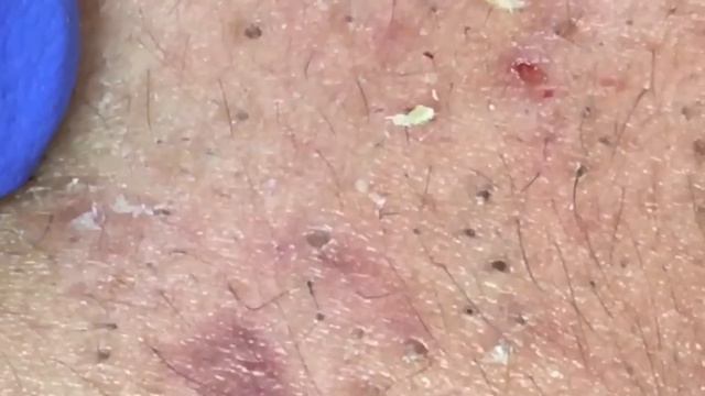 Blackheads Extractions “K’s” 4th Treatment