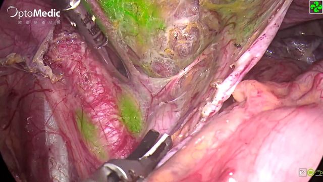 Gynecology Pelvic Lymph Node Labeling смотреть онлайн