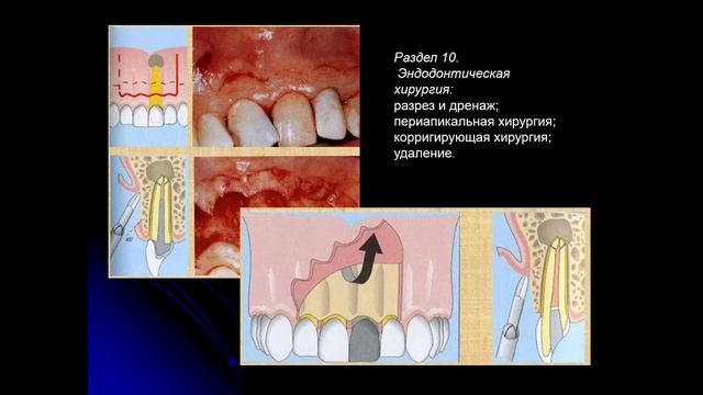 Пропедевтика стом. заболеваний 9. Методика распломбирования корневых каналов