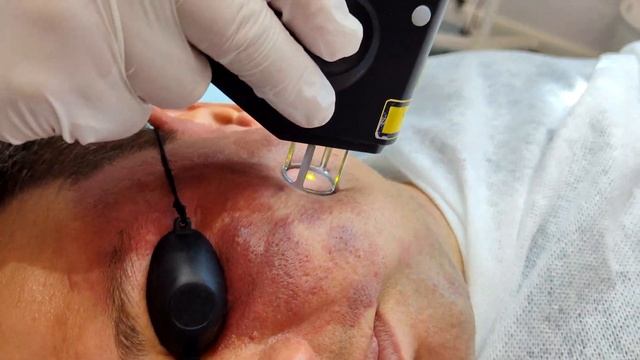 Невус - "Винное пятно" лечение лазером смотреть онлайн