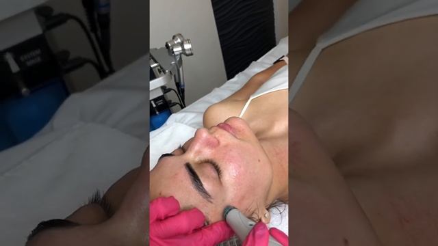 Процедура чистки лица Hydrafacial
