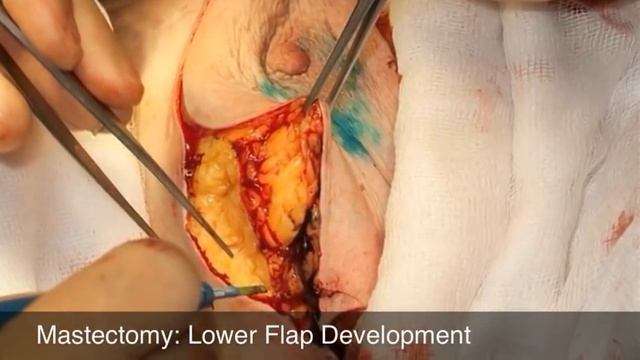 Mastectomy & Sentinel Node Biopsy смотреть онлайн