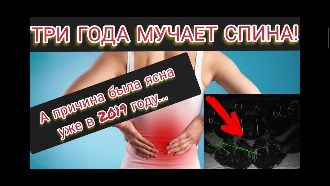 Три года болит спина! Сравнение МРТ 2019 года и 2022 года/ Боль от мышц или неверное лечение? смотреть онлайн