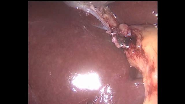 Laparoscopic cholecystectomy. Небруталы хирургируют "голубой пузырек"-43 смотреть онлайн