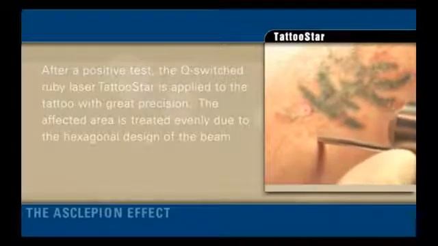 Удаление татуировок Q-Switched лазером TattooStar R Асклепион смотреть онлайн
