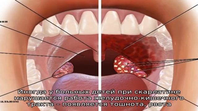 Налет на гландах и миндалинах у ребенка смотреть онлайн